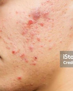 Pimples